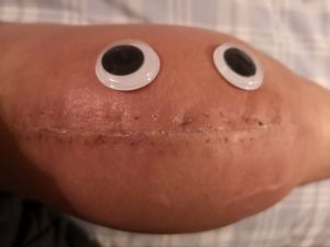 Picture of a swollen knee lying sideways across the picture (top on the left, bottom on the right). THe knee has a large scar down the front of it which look like teeth. Googly eyes have been stuck on it to finish a somewhat grisly face!