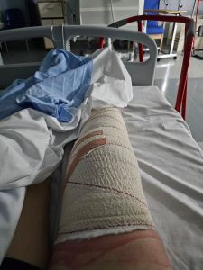 Picture of a bandaged leg on a hospital bed. There’s a blue blanket and hints of a scarlet walking frame parked at the end. The bandage is crepe and fastened with buff coloured plaster.